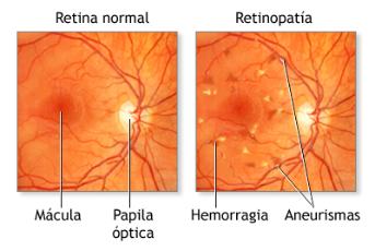 IA Retinopatia